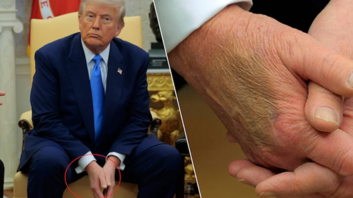 Main marquée de Donald Trump : des experts médicaux s’interrogent sur l’origine des mystérieuses ecchymoses